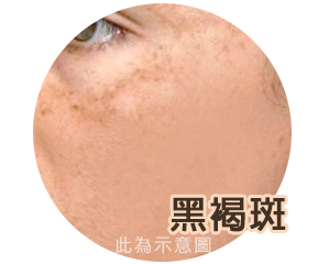 渾然天成,雷射除斑