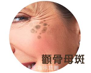 渾然天成,雷射除斑