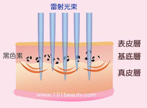 渾然天成,雷射除斑