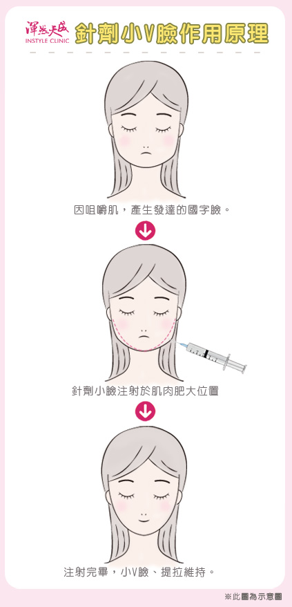 渾然天成整形醫美|針劑小V臉作用原理 渾然天成整形醫美|針劑小V臉作用原理