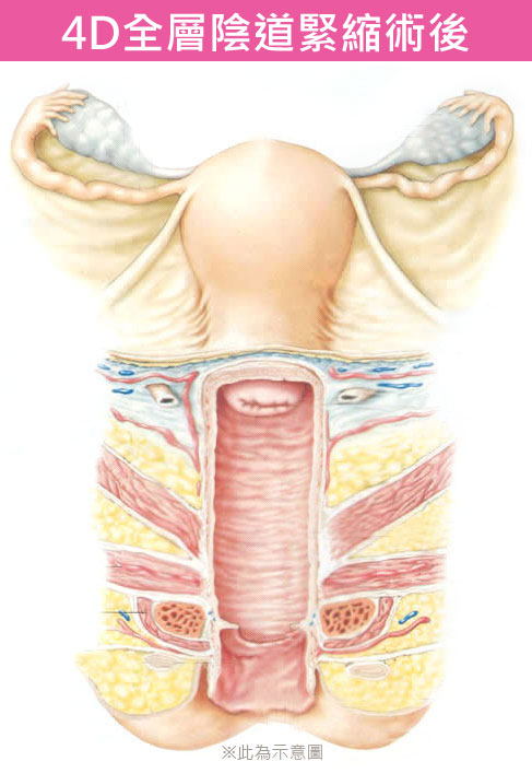 陰道管徑,陰道長度,陰道鬆弛,渾然天成,陳淑賢醫師,剖腹產,自然產,陰道嚴重鬆弛,產後陰道鬆弛