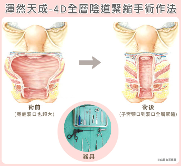 渾然天成整形醫美|渾然天成-4D全層陰道緊縮手術作法 渾然天成整形醫美|渾然天成-4D全層陰道緊縮手術作法
