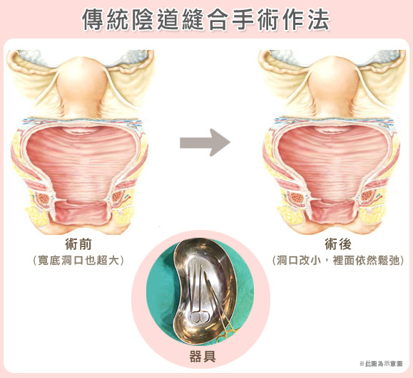 渾然天成整形醫美|傳統陰道縫合手術作法 渾然天成整形醫美|傳統陰道縫合手術作法