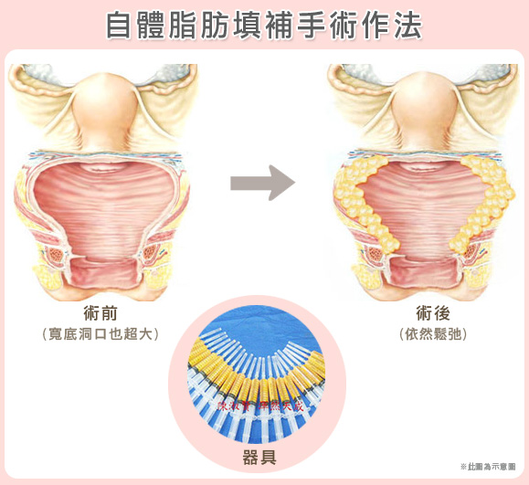 渾然天成整形醫美|渾然天成-自體脂肪填補手術作法 渾然天成整形醫美|渾然天成-自體脂肪填補手術作法