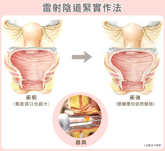 渾然天成整形醫美|渾然天成-電波/雷射陰道保養 渾然天成整形醫美|渾然天成-電波/雷射陰道保養