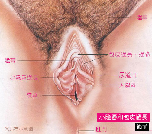 小陰唇,私密處,變黑,過長,女性包皮,渾然天成,困擾,小陰脣