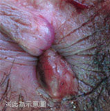 各種型態的痔瘡 各種型態的痔瘡