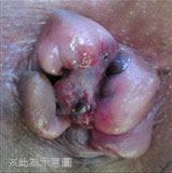 各種型態的痔瘡 各種型態的痔瘡
