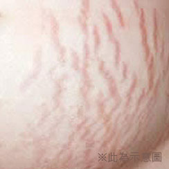 妊娠紋|渾然天成醫美診所 妊娠紋|渾然天成醫美診所