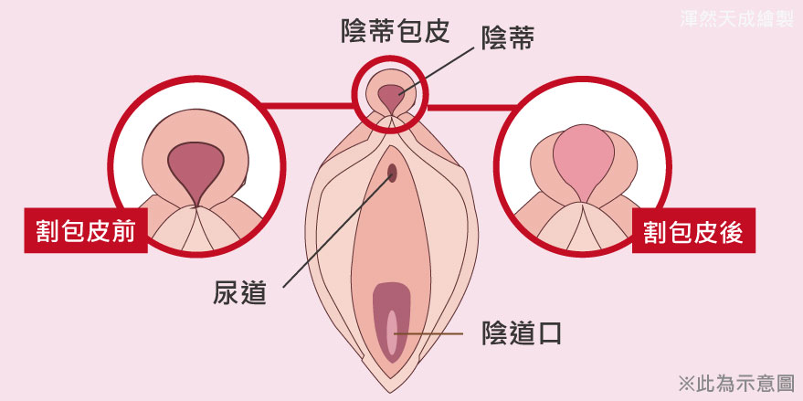 小陰唇,私密處,整形,手術,女性包皮,渾然天成,困擾,小陰脣