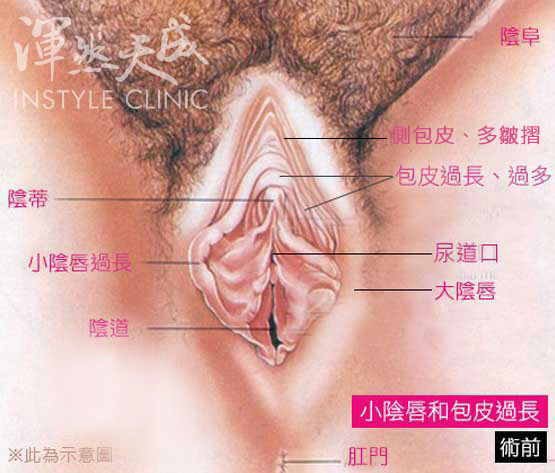 小陰唇過長、包皮過長(術前) 小陰唇過長、包皮過長(術前)