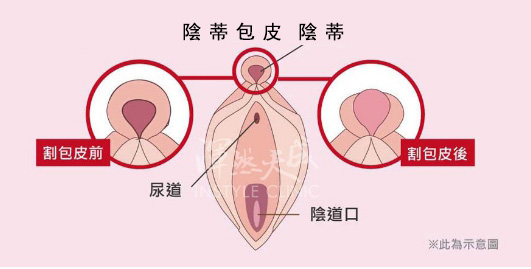 女性包皮(陰蒂包皮)構造 女性包皮(陰蒂包皮)構造
